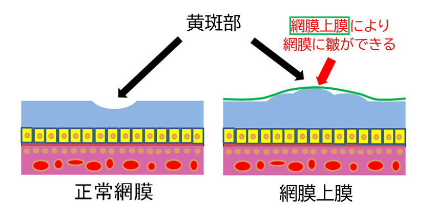  ERMの悪化を防ぐことは可能でしょうか?