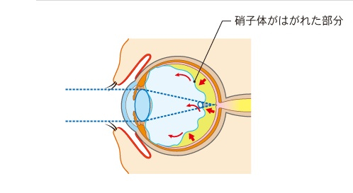 後部硝子体剥離による飛蚊症