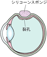強膜バックリング術