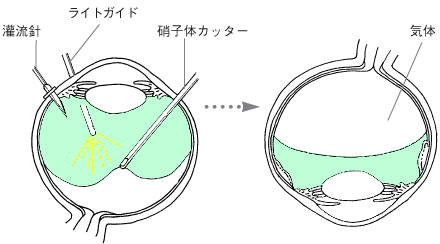 硝子体手術