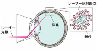 網膜光凝固術