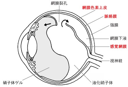 網膜剥離