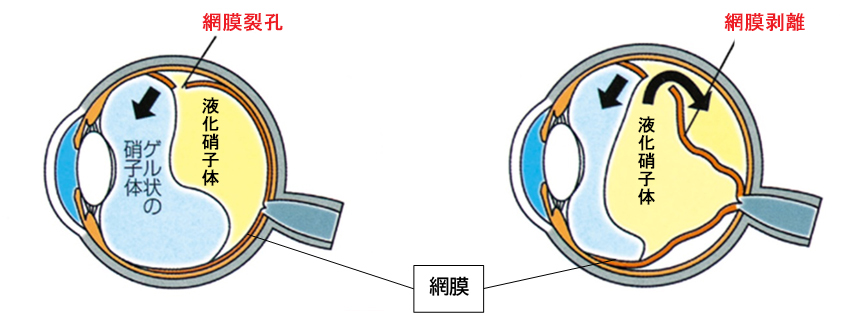 網膜裂孔と網膜剥離