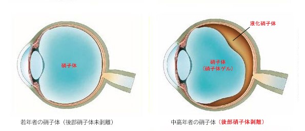 裂孔原性網膜剥離